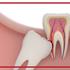 آیا ریشه دندان عقل قابل درمان است؟
